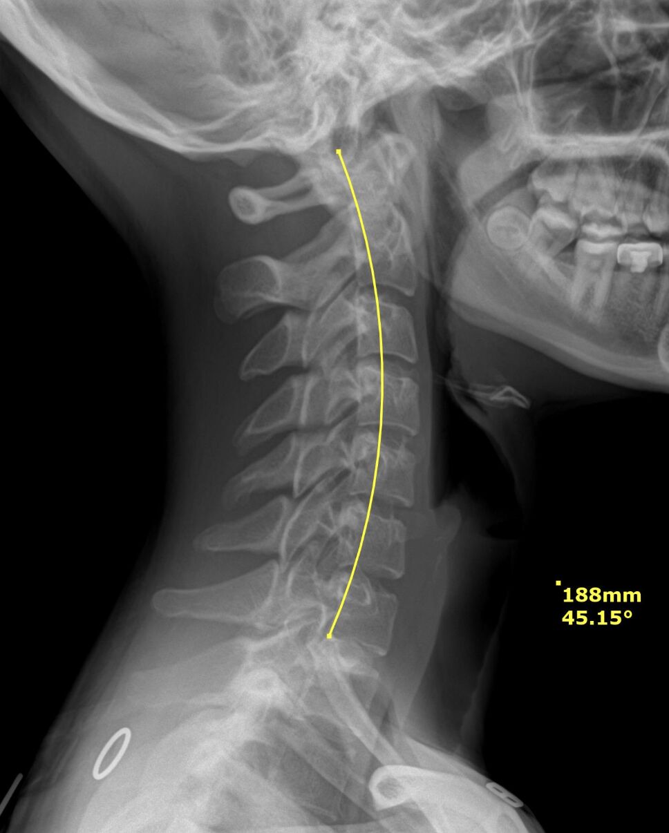 Cervical spine X-ray after corrective care showing restored neck curve at Envision Chiropractic Bellingham
