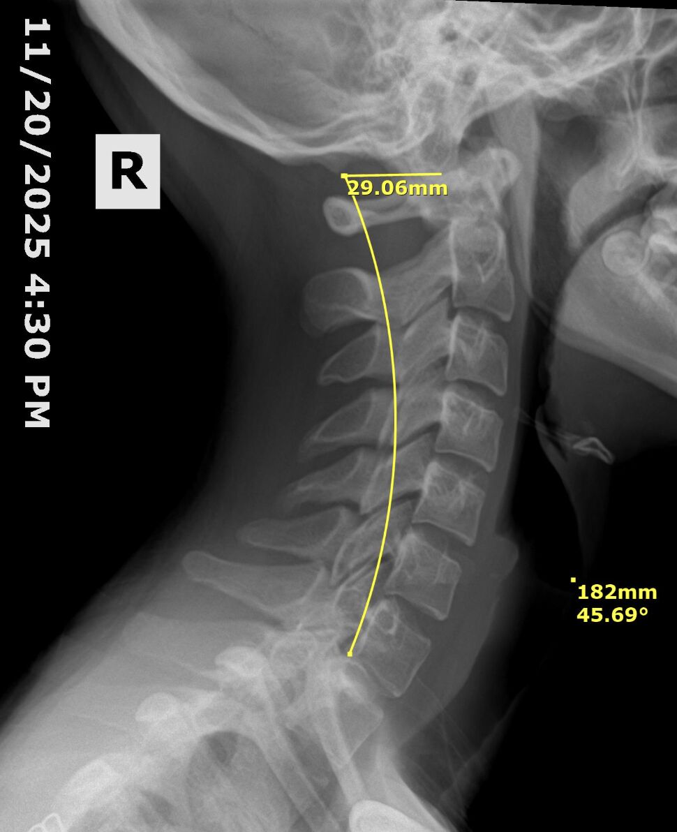 Cervical spine X-ray before corrective care showing reduced neck curve at Envision Chiropractic Bellingham