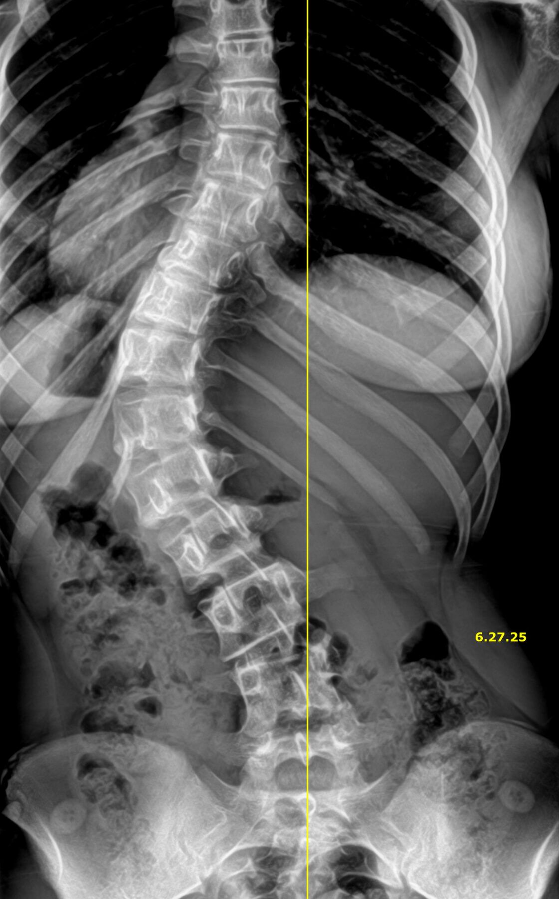 Before-and-after spinal X-ray showing postural correction at Envision Chiropractic Bellingham